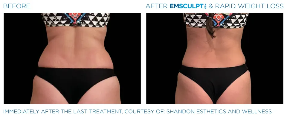 Emsculpt Neo before and after