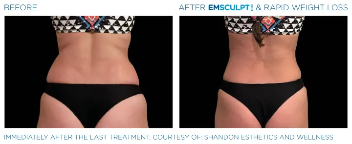 Emsculpt Neo - Before and After