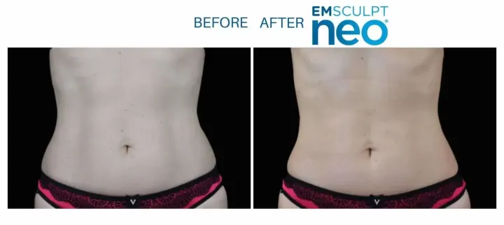 Emsculpt Neo - Before and After